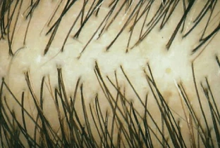 Antes de Folicerin: cabello con signos de caída.