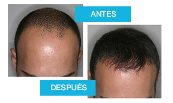 Resultados antes y después de Profolan: detiene la caída y aumenta la densidad capilar.