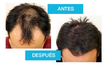 Transformación capilar con Profolan: mejora en el crecimiento y densidad.