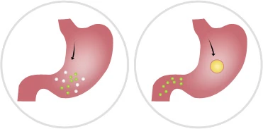 Resultados Silvets: Comparación antes y después del tratamiento para adelgazar.